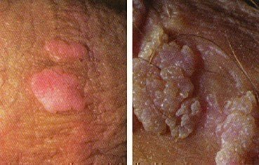 vaginal warts