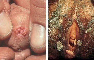 vaginal warts