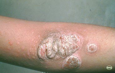 Psoriasis Specialists NYC