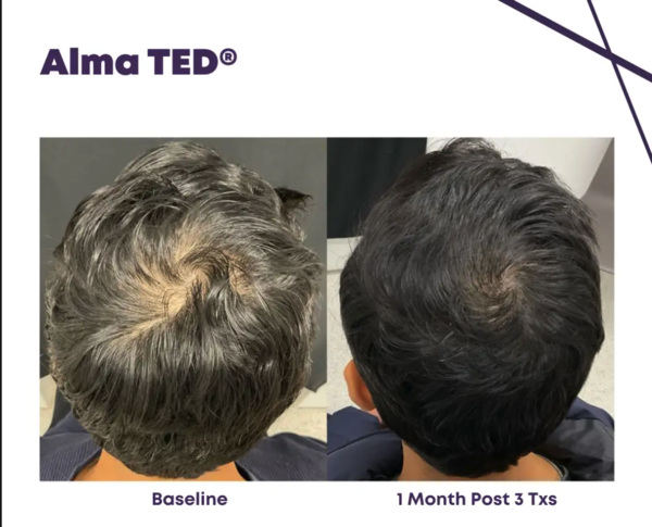 Alma TED+ before and after.